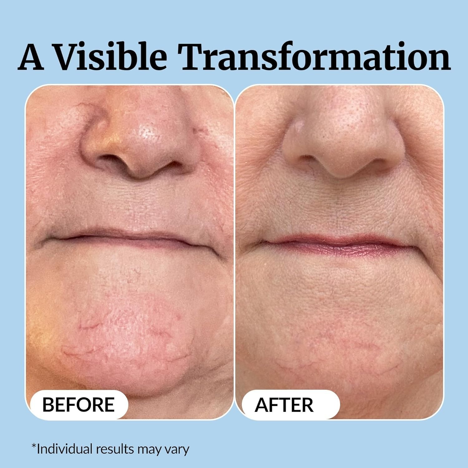 Reduce Fine Lines and Age Spots – Vibriance Super C Serum 1 Fl Oz