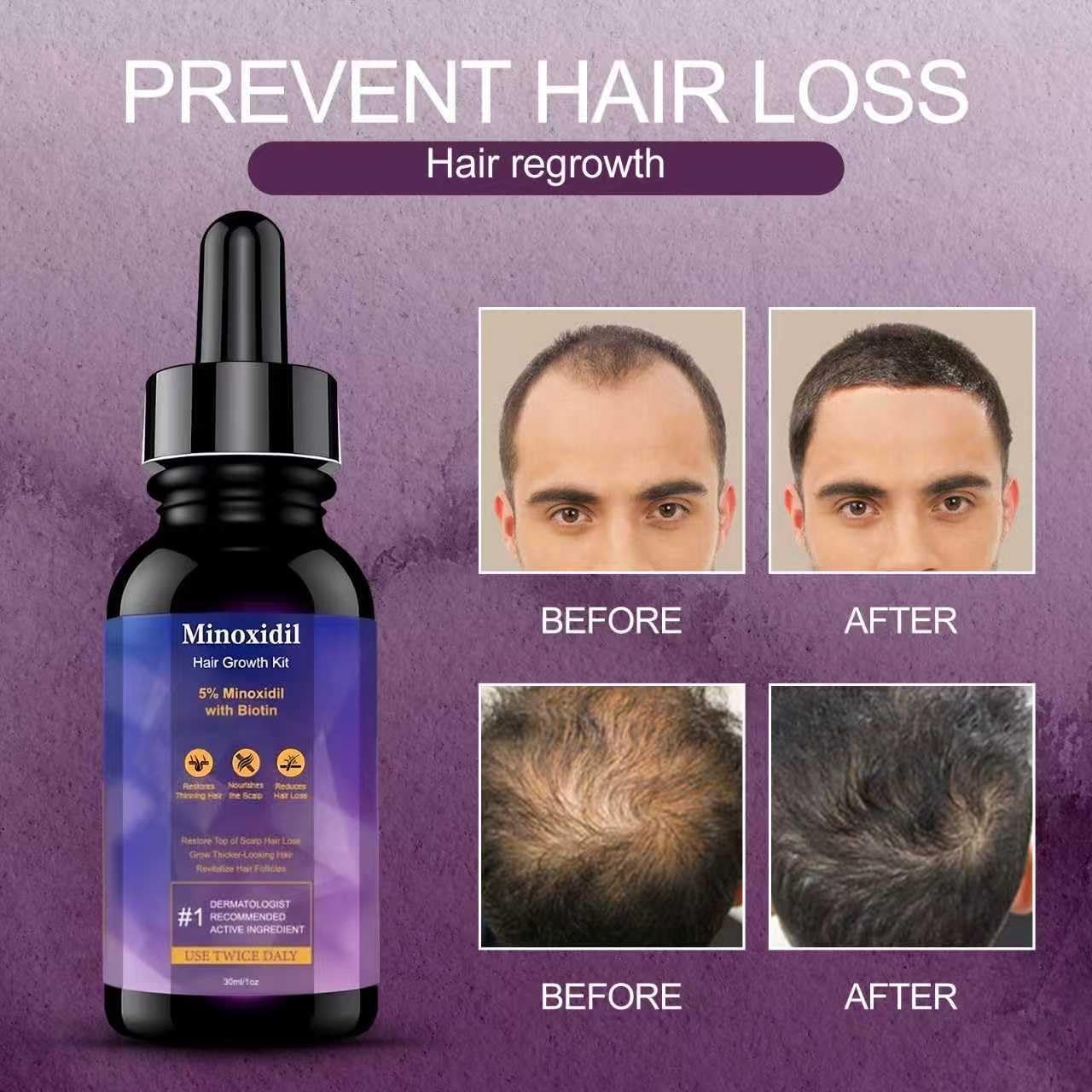 Hair Growth Treatment for Thicker Longer, 5% Minoxidil Biotin Hair Growth Serum