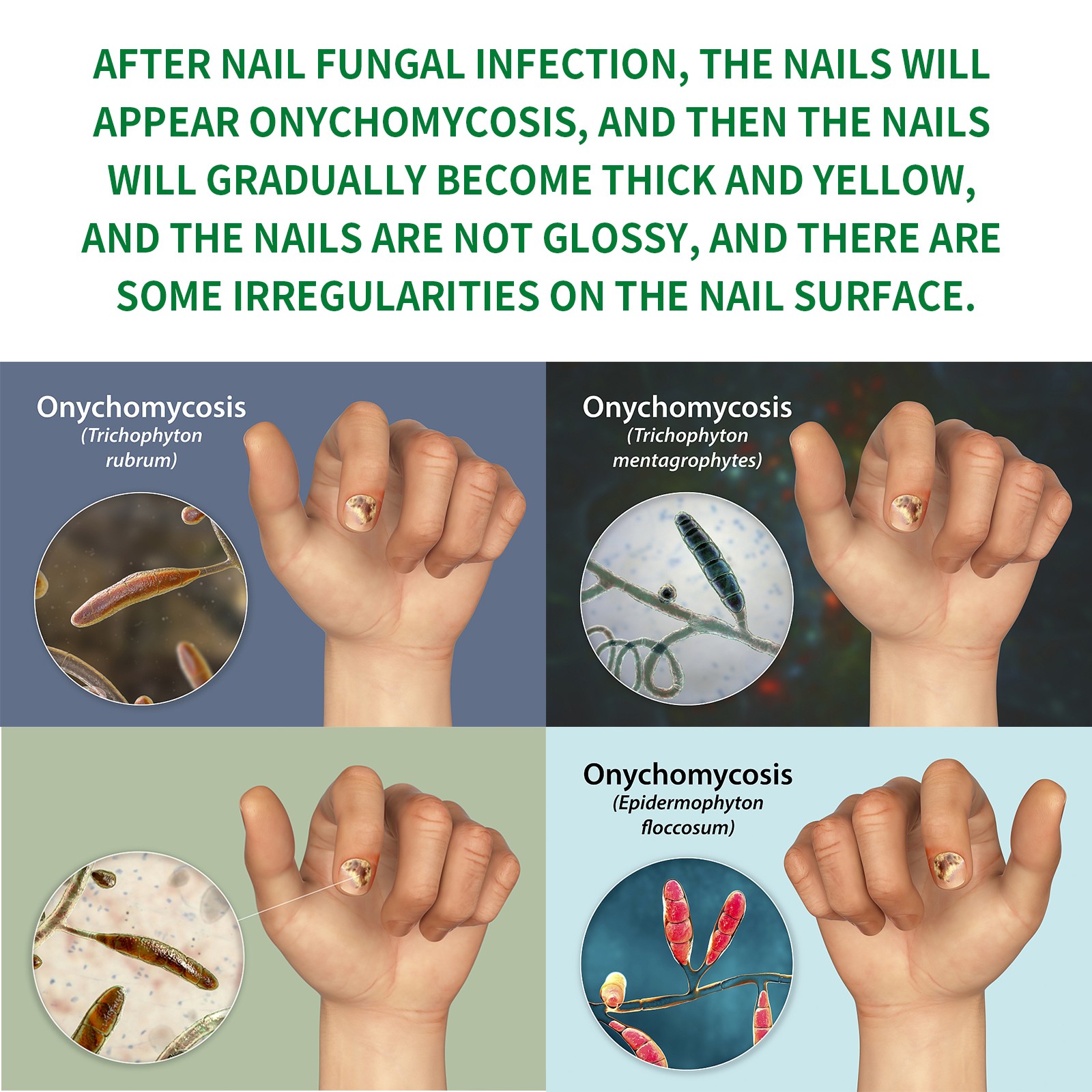 Jaysuing Ginger Nail Care Liquid Gently Caresses Hands And Feet, Flattens The Na