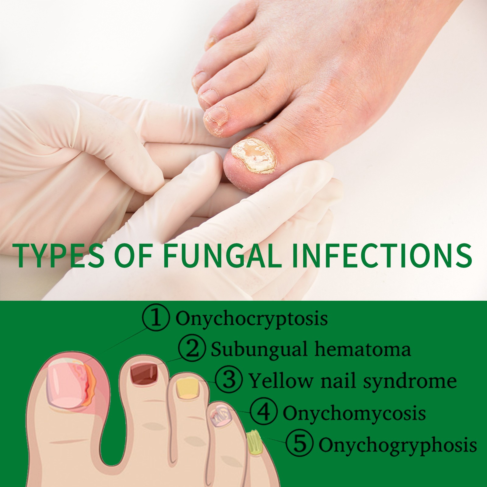 Jaysuing Ginger Nail Care Liquid Gently Caresses Hands And Feet, Flattens The Na
